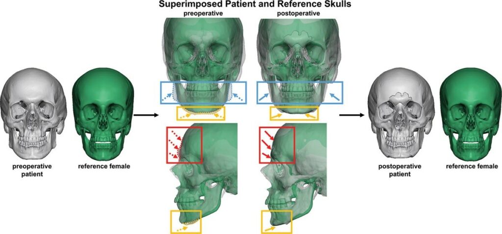 Facial Fenimization